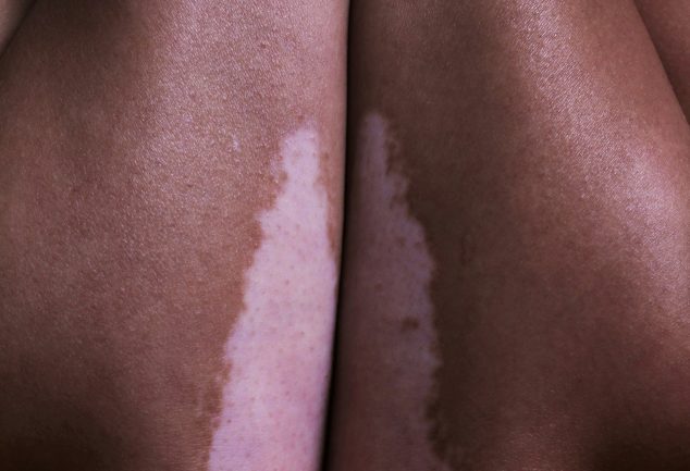 Vitiligo